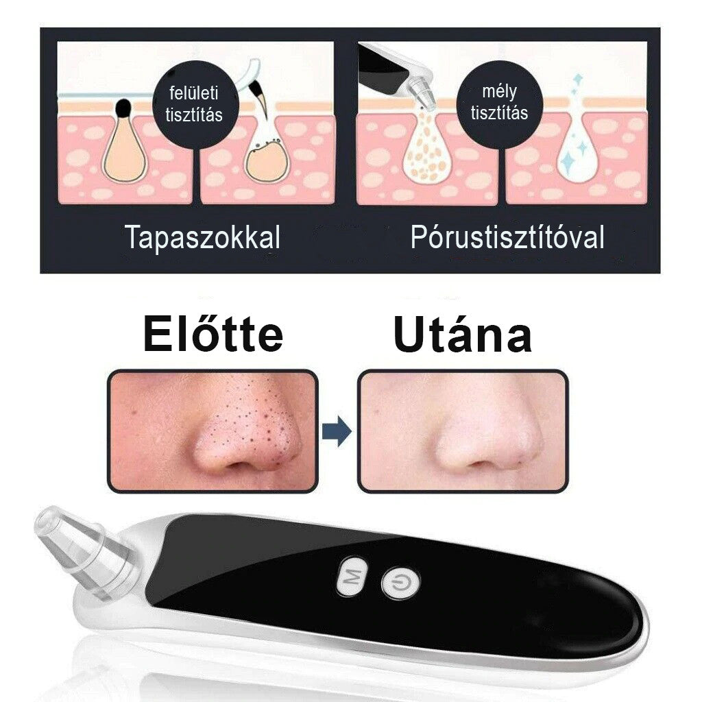 Pórustisztító készülék, Mitesszer Eltávolító, Mélytisztító
